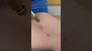 How a dermatologist removes a WART on a leg! #liquidnitrogen #wartsremoval