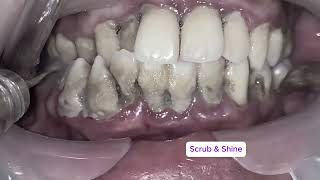 Can You Watch Till the End? Top 3 Most Impressive  Tartar Removals!#