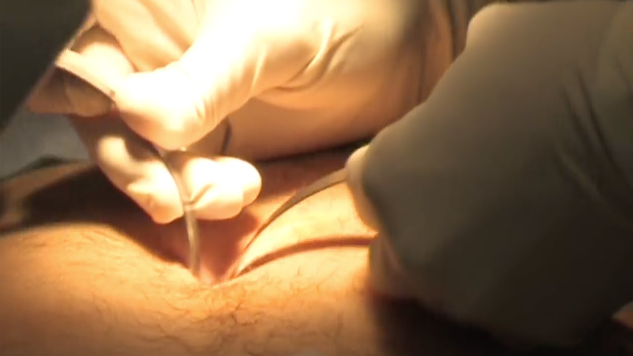 Laparoscopic appendicectomy (appendectomy)