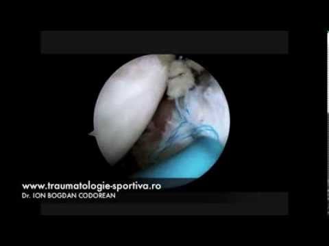 Artroza tratamentului articulației genunchiului și a activității fizice