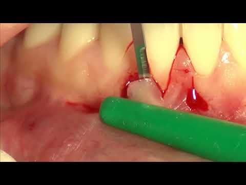 Bilaminar technique on single incisor on the lower jaw. Джованни Зуккелли