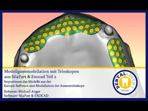 Modellgussmodellation mit Teleskopen aus SilaPart & Exocad Teil 1