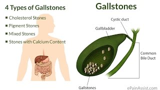 Drinking apple cider to flush out gall bladder stones [ENG SUB]