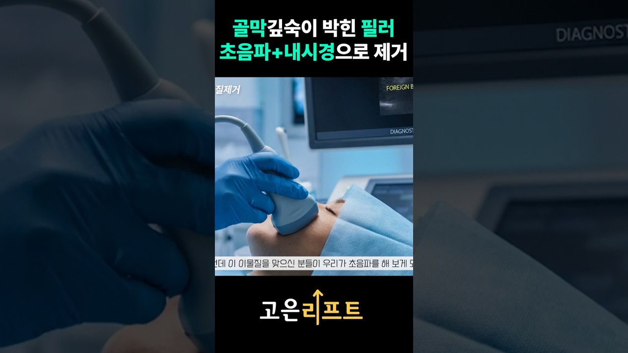 고은리프트 초음파 필러제거 유튜브 영상