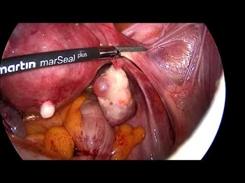 marSeal5 plus – Total laparoscopic hysterectomy