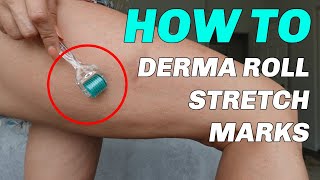HOW TO GET RID OF STRETCH MARKS - Using a Dermaroller for AMAZING Results