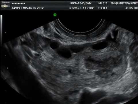 Corpus Luteum on Transvaginal Ultrasound