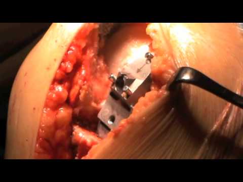 Autunno esacerbazione di osteocondrosi Dolore alle articolazioni e abbassare di nuovo a destra