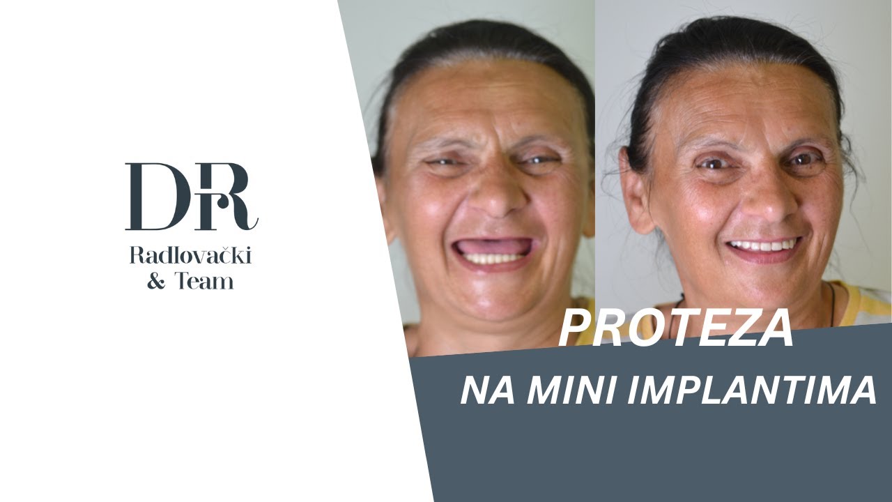Video iskustvo pacijenta — proteza na mini implantima (3)