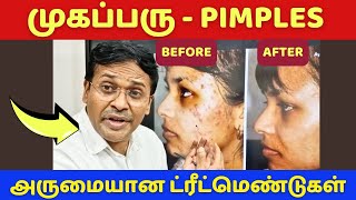 How to remove pimples on face at home?