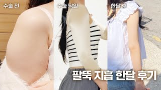 팔뚝 지방흡입 무보정 한달 후기
