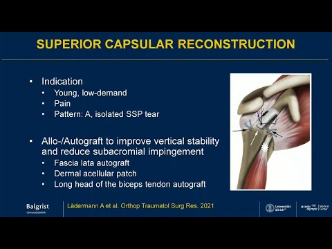 Balgrist explains: Irreparable rotator cuff tear | Irreparable Rotator Cuff Tear
