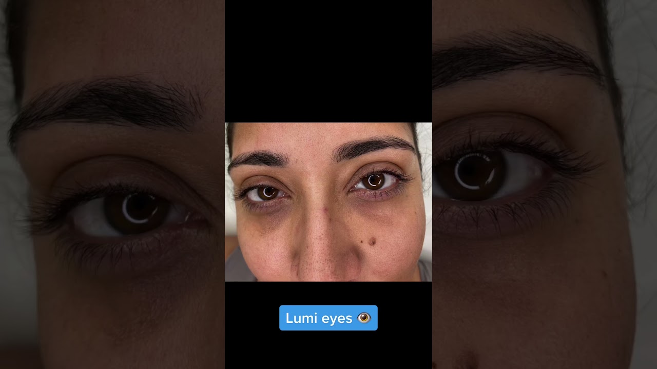 Lumi Eye Treatment EXPOSED My Shocking Results
