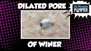 Dilated Pore of Winer (Giant blackhead!)