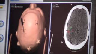 AutoLITT - A Minimally Invasive Brain Tumor Treatm