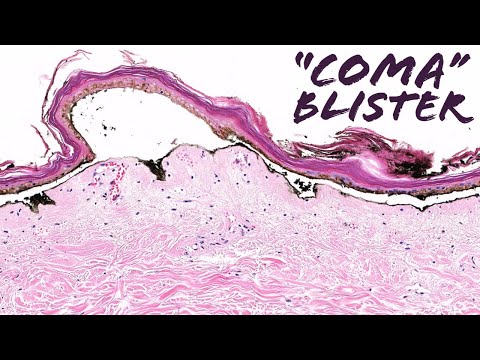 Coma Blister (pressure induced ischemia of skin blister) (Stony Brook case 6) dermatology dermpath
