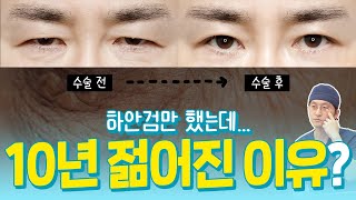 하안검 성형 아무나 하면 안 되는 이유😨 ㅣ 하안검 부작용, 재발 ㅣ 성형외과전문의