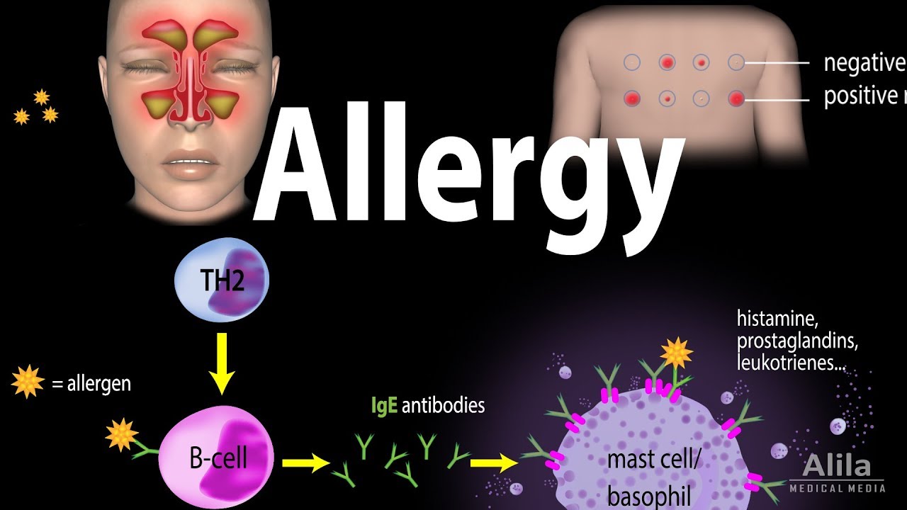 Allergy - Mechanism, Symptoms, Risk factors, Diagnosis, Treatment and Prevention, Animation