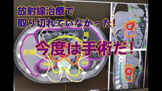 【大腸がんステージⅣ多発肝転移】リンパに再発！大きさ３㎝！でも、まだ諦めない治療！！【現在闘病中㉘】