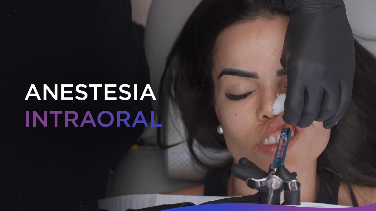 Anestesia Intraoral: Como fazer