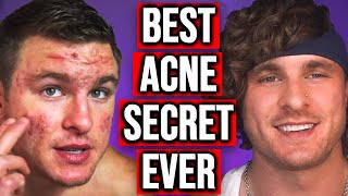 Stop Doing THIS If You Want To Get Rid of Your Acne!