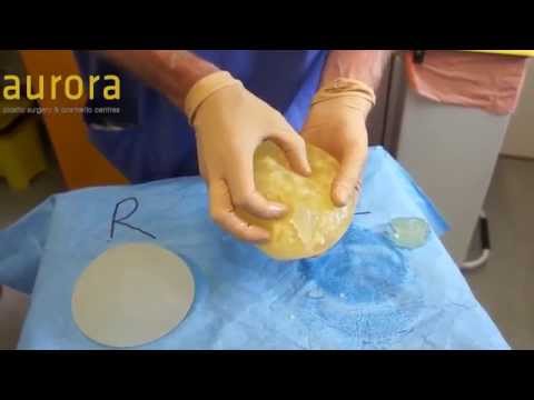 Single PIP Rupture and Mastopexy procedure