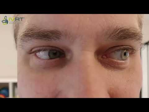 Nystagmus bei Neuritis / Neuropathia Vestibularis