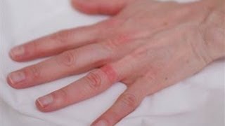 DermTV - Wedding Ring Eczema [DermTV.com Epi #111]