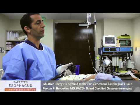 Radiofrequency Ablation (RFA) Therapy for Treating Barrett's Esophagus