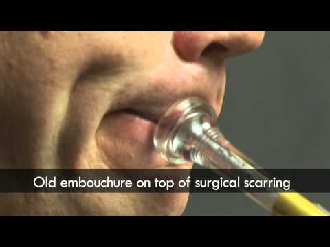 Trumpet embouchure before and after surgery