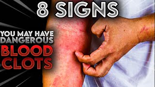 8 Signs and Symptons That You May Have DANGEROUS Blood Cloths