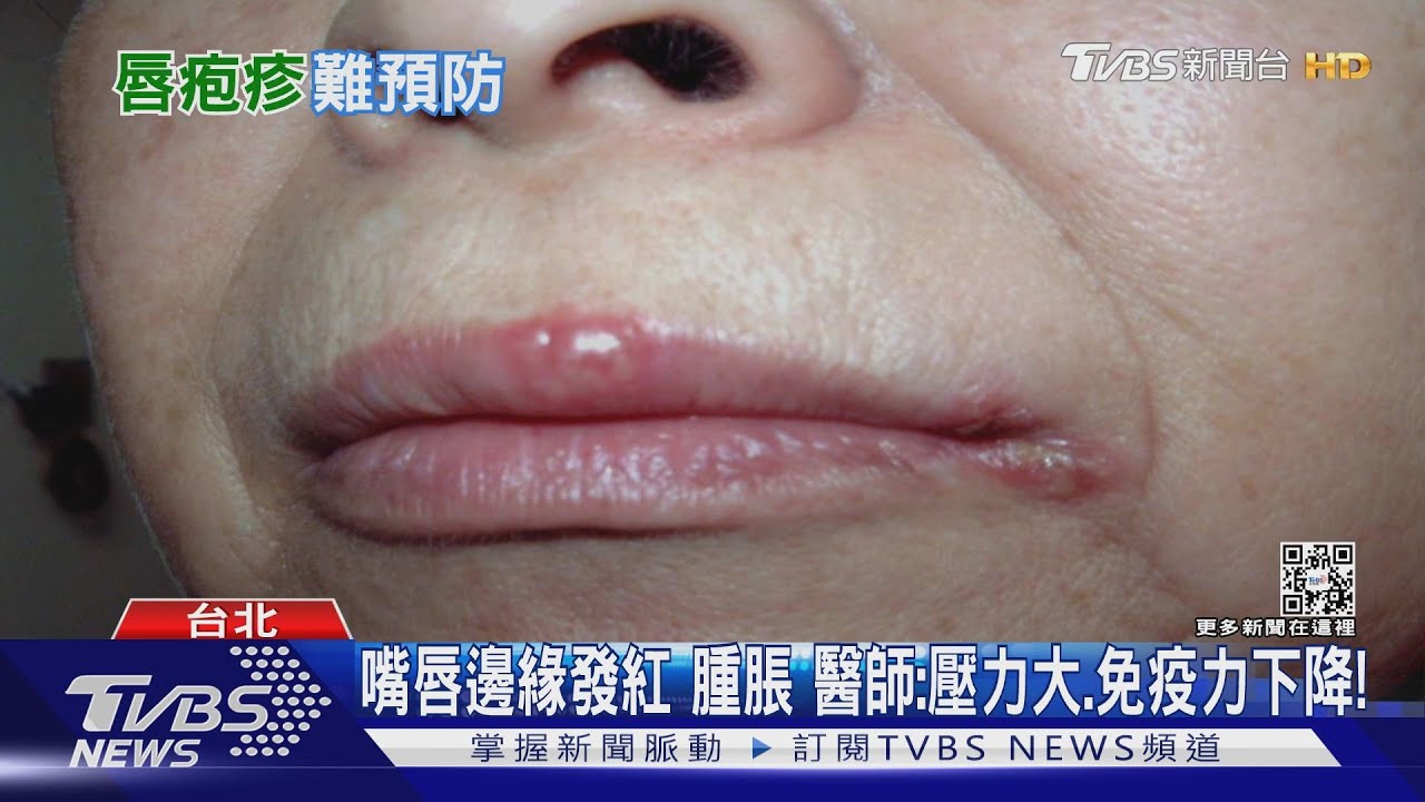免疫力下降、熬夜、壓力大...「這部位」冒出疱疹...　醫警告別做這件事...