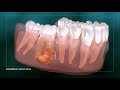 Dental Abcess - Why Root Canal Treatment Is Needed