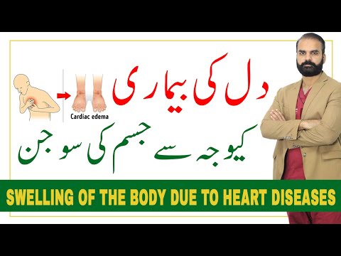 Swelling of body due to Heart disease ?Cardiac edema in Hindi/Urdu?