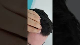 Healed Scalp Hair Simulation Micropigmentation (1 session only) by El Truchan @ Perfect Definition