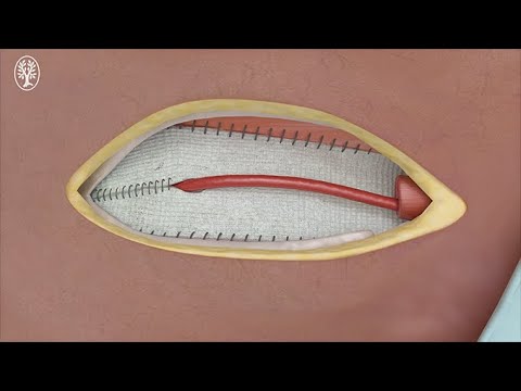 Operativer Verschluss eines Leistenbruches