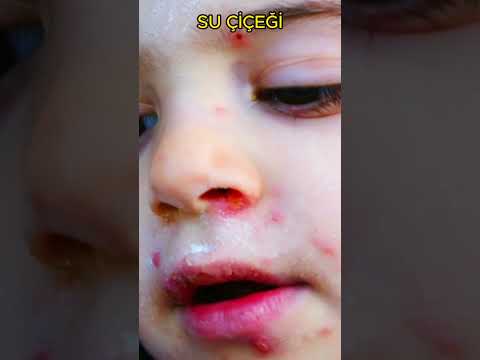 "Su Çiçeği Hakkında Bilinmeyen Gerçekler! 🌟🦠 Kaçırmayın! #SuÇiçeği #HastalıkBilgisi"