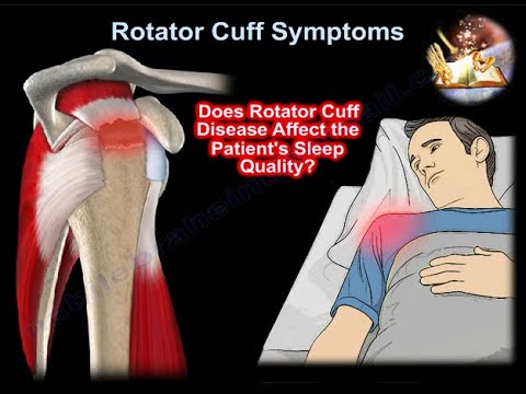 Rotator Cuff Symptoms Sleep Disorders  - Everything You Need To Know - Dr. Nabil Ebraheim