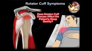 Rotator Cuff Symptoms Sleep Disorders  - Everything You Need To Know - Dr. Nabil Ebraheim