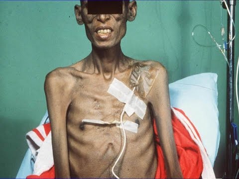 EDUARDO BRUERA, MD 'Cancer Related Cachexia'