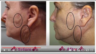 Fibrosis to Face After a Face Lift : Aspen Facelift Treatment for Lumpy Knots