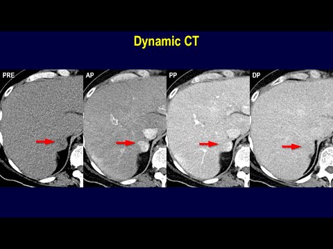 Is this a HCC (LR-5 lesion)? - Hypervascular & washout nodule in a 47-y.o. woman with cirrhosis