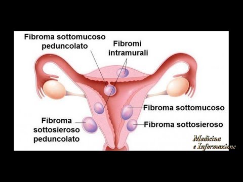 Dolore persistente alla schiena sotto le scapole Osteocondrosi thoracolumbar nellICD codice 10