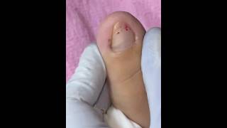 Ep_8750 Foot nails skin removal 👣 ทำไมพี่เอื้อมงัดหนัง..ต้องเลือดออก 😅 (clip from Thailand)