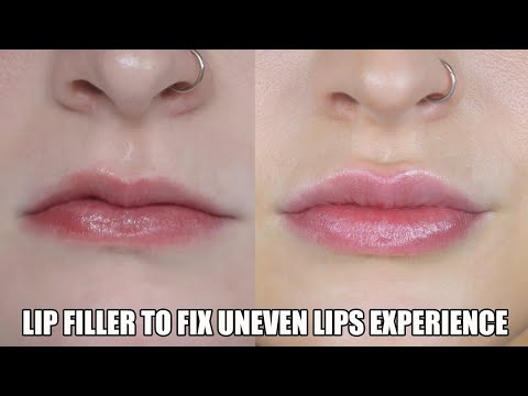 I Got Lip Filler For The First Time! | Vlog + Daily Check Ins