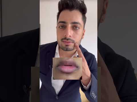 Do you have cracked lip corners?