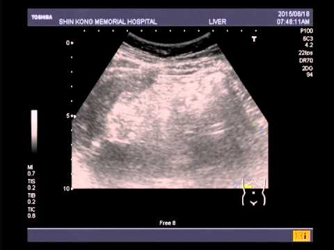 11M, complained diffuse abdominal pain (esp. RUQ and RLQ)