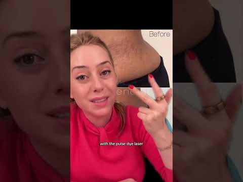 Stretch Marks Transformation Part 2 #shorts