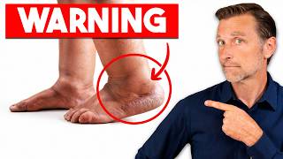 The #1 Mineral Deficiency Behind Swollen Feet & Ankles