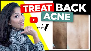How To Treat Back Acne FAST | Doctors Tips | Skin of Colour Asian/Black | Treat Backne | DR V